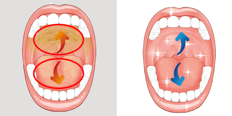 汚れが上あごに